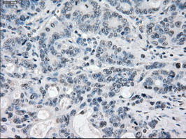 PPP5C Antibody - IHC of paraffin-embedded Adenocarcinoma of colon tissue using anti-PPP5C mouse monoclonal antibody. (Dilution 1:50).