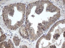 PPT1 / CLN1 Antibody - IHC of paraffin-embedded Carcinoma of Human prostate tissue using anti-PPT1 mouse monoclonal antibody.
