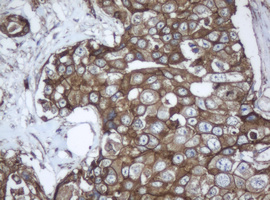 PPT1 / CLN1 Antibody - IHC of paraffin-embedded Adenocarcinoma of Human breast tissue using anti-PPT1 mouse monoclonal antibody.