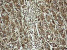 PPT1 / CLN1 Antibody - IHC of paraffin-embedded Carcinoma of Human liver tissue using anti-PPT1 mouse monoclonal antibody.