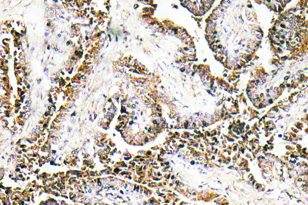 PPT1 / CLN1 Antibody - Immunohistochemistry analysis of CLN1 antibody in paraffin-embedded human prostate carcinoma tissue.