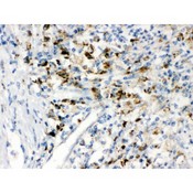 PPT1 / CLN1 Antibody - PPT1 antibody IHC-paraffin. IHC(P): Human Intestinal Cancer Tissue.