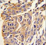 PPT1 / CLN1 Antibody - Formalin-fixed and paraffin-embedded human lung carcinoma tissue reacted with PPT1 antibody , which was peroxidase-conjugated to the secondary antibody, followed by DAB staining. This data demonstrates the use of this antibody for immunohistochemistry; clinical relevance has not been evaluated.