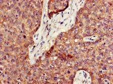 PPT1 / CLN1 Antibody - Immunohistochemistry of paraffin-embedded human ovarian cancer at dilution of 1:100