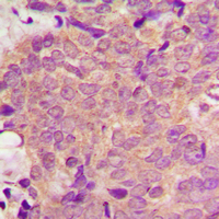PPT1 / CLN1 Antibody - Immunohistochemical analysis of PPT staining in human breast cancer formalin fixed paraffin embedded tissue section. The section was pre-treated using heat mediated antigen retrieval with sodium citrate buffer (pH 6.0). The section was then incubated with the antibody at room temperature and detected using an HRP conjugated compact polymer system. DAB was used as the chromogen. The section was then counterstained with hematoxylin and mounted with DPX.