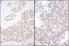PQBP1 Antibody - Detection of Human and Mouse PQBP1 by Immunohistochemistry. Sample: FFPE section of human breast carcinoma (left) and mouse teratoma (right). Antibody: Affinity purified rabbit anti-PQBP1 used at a dilution of 1:200 (1 ug/mg).