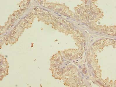 PQLC3 Antibody - Immunohistochemistry of paraffin-embedded human prostate cancer using antibody at dilution of 1:100.