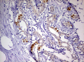PR / Progesterone Receptor Antibody - IHC of paraffin-embedded Human breast tissue using anti-PGR mouse monoclonal antibody. (Heat-induced epitope retrieval by 10mM citric buffer, pH6.0, 120°C for 3min).