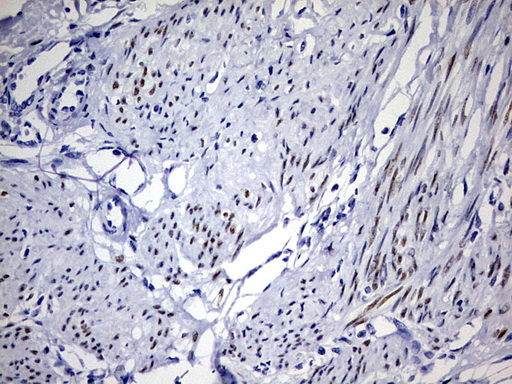 PR / Progesterone Receptor Antibody - IHC of paraffin-embedded Human endometrium tissue using anti-PGR mouse monoclonal antibody. (Heat-induced epitope retrieval by 1 mM EDTA in 10mM Tris, pH9.0, 120°C for 3min).