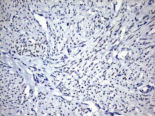 PR / Progesterone Receptor Antibody - IHC of paraffin-embedded Adenocarcinoma of Human endometrium tissue using anti-PGR mouse monoclonal antibody. (Heat-induced epitope retrieval by 1 mM EDTA in 10mM Tris, pH9.0, 120°C for 3min).