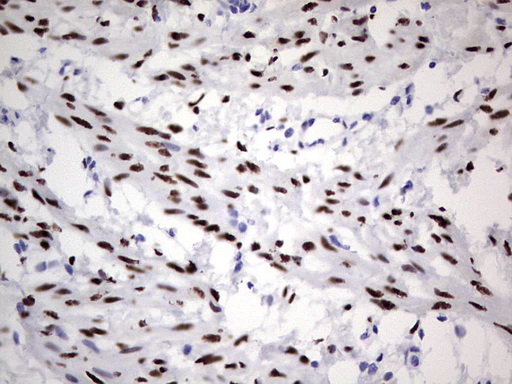 PR / Progesterone Receptor Antibody - IHC of paraffin-embedded Human endometrium tissue using anti-PGR mouse monoclonal antibody. (Heat-induced epitope retrieval by 1 mM EDTA in 10mM Tris, pH8.5, 120°C for 3min).