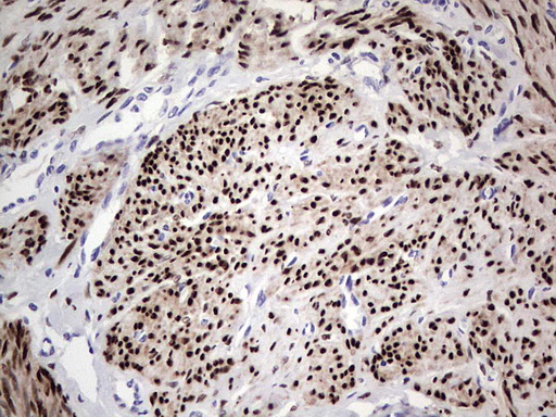 PR / Progesterone Receptor Antibody - IHC of paraffin-embedded Adenocarcinoma of Human endometrium tissue using anti-PGR mouse monoclonal antibody. (Heat-induced epitope retrieval by 1 mM EDTA in 10mM Tris, pH8.5, 120°C for 3min).