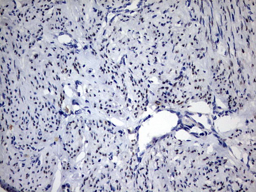 PR / Progesterone Receptor Antibody - IHC of paraffin-embedded Adenocarcinoma of Human endometrium tissue using anti-PGR mouse monoclonal antibody. (Heat-induced epitope retrieval by 1 mM EDTA in 10mM Tris, pH9.0, 120°C for 3min).