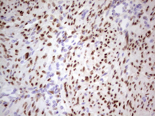 PR / Progesterone Receptor Antibody - IHC of paraffin-embedded Human endometrium tissue using anti-PGR mouse monoclonal antibody. (heat-induced epitope retrieval by 1 mM EDTA in 10mM Tris, pH8.5, 120°C for 3min).