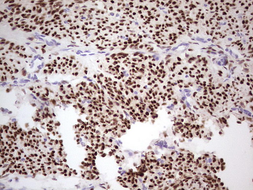 PR / Progesterone Receptor Antibody - IHC of paraffin-embedded Adenocarcinoma of Human endometrium tissue using anti-PGR mouse monoclonal antibody. (heat-induced epitope retrieval by 1 mM EDTA in 10mM Tris, pH8.5, 120°C for 3min).