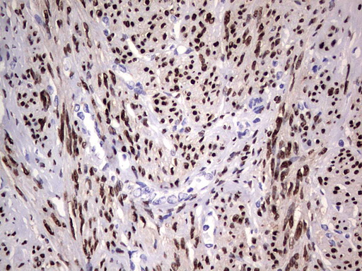 PR / Progesterone Receptor Antibody - IHC of paraffin-embedded Human endometrium tissue using anti-PGR mouse monoclonal antibody. (Heat-induced epitope retrieval by 1 mM EDTA in 10mM Tris, pH8.5, 120°C for 3min).