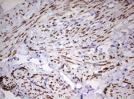 PR / Progesterone Receptor Antibody - IHC of paraffin-embedded Adenocarcinoma of Human endometrium tissue using anti-PGR mouse monoclonal antibody. (Heat-induced epitope retrieval by 10mM citric buffer, pH6.0, 120°C for 3min).