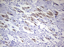PR / Progesterone Receptor Antibody - IHC of paraffin-embedded Adenocarcinoma of Human ovary tissue using anti-PGR mouse monoclonal antibody. (Heat-induced epitope retrieval by 10mM citric buffer, pH6.0, 120°C for 3min).