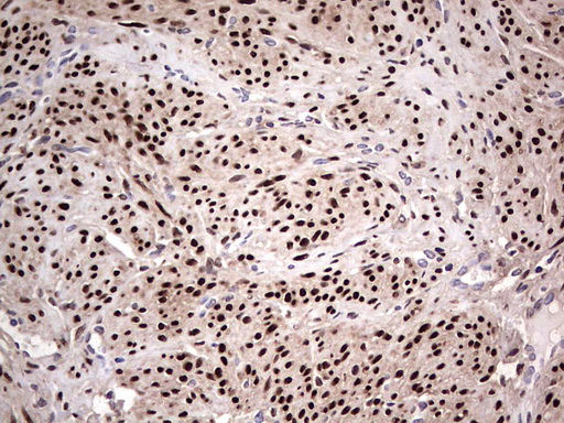 PR / Progesterone Receptor Antibody - IHC of paraffin-embedded Human endometrium tissue using anti-PGR mouse monoclonal antibody. (Heat-induced epitope retrieval by 1 mM EDTA in 10mM Tris, pH8.5, 120°C for 3min).