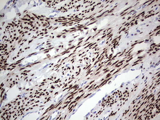 PR / Progesterone Receptor Antibody - IHC of paraffin-embedded Adenocarcinoma of Human endometrium tissue using anti-PGR mouse monoclonal antibody. (Heat-induced epitope retrieval by 1 mM EDTA in 10mM Tris, pH8.5, 120°C for 3min).