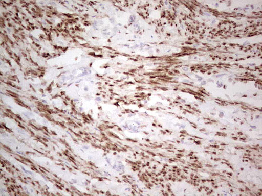 PR / Progesterone Receptor Antibody - IHC of paraffin-embedded Adenocarcinoma of Human endometrium tissue using anti-PGR mouse monoclonal antibody. (Heat-induced epitope retrieval by 1 mM EDTA in 10mM Tris, pH8.5, 120°C for 3min).