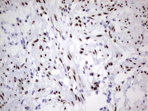 PR / Progesterone Receptor Antibody - Immunohistochemical staining of paraffin-embedded Human endometrium tissue within the normal limits using anti-PGR mouse monoclonal antibody. (Heat-induced epitope retrieval by 1 mM EDTA in 10mM Tris, pH8.5, 120C for 3min,