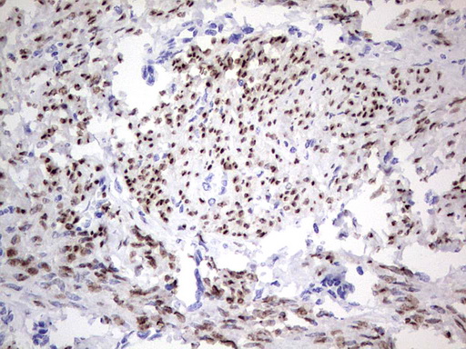 PR / Progesterone Receptor Antibody - Immunohistochemical staining of paraffin-embedded Adenocarcinoma of Human endometrium tissue using anti-PGR mouse monoclonal antibody. (Heat-induced epitope retrieval by 1 mM EDTA in 10mM Tris, pH8.5, 120C for 3min,