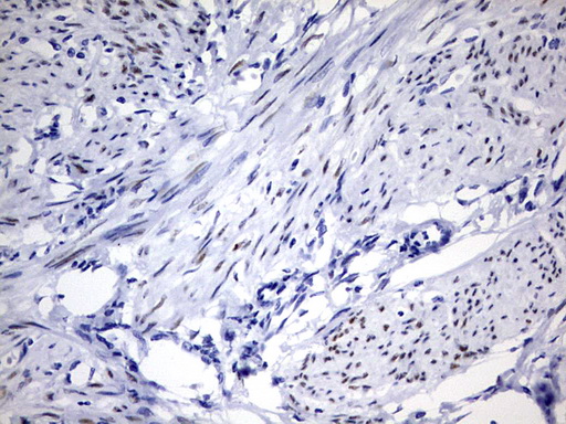 PR / Progesterone Receptor Antibody - IHC of paraffin-embedded Human endometrium tissue using anti-PGR mouse monoclonal antibody. (Heat-induced epitope retrieval by 1 mM EDTA in 10mM Tris, pH9.0, 120°C for 3min).