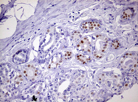 PR / Progesterone Receptor Antibody - IHC of paraffin-embedded Human breast tissue using anti-PGR mouse monoclonal antibody. (Heat-induced epitope retrieval by 10mM citric buffer, pH6.0, 120°C for 3min).