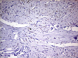 PR / Progesterone Receptor Antibody - IHC of paraffin-embedded Human endometrium tissue using anti-PGR mouse monoclonal antibody. (Heat-induced epitope retrieval by 10mM citric buffer, pH6.0, 120°C for 3min).