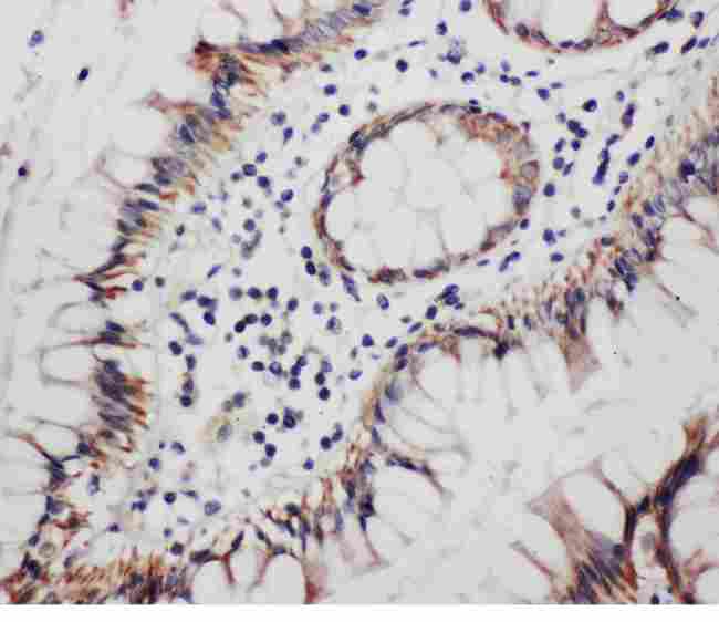 PR / Progesterone Receptor Antibody - Anti-Progesterone Receptor antibody, IHC(P): Human Rectal Cancer Tissue
