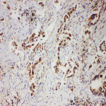 PR / Progesterone Receptor Antibody - PGR/PR/Progesterone Receptor antibody. IHC(P): Human Lung Cancer Tissue.