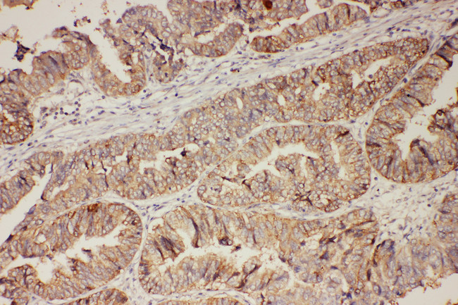PR / Progesterone Receptor Antibody - PGR/PR/Progesterone Receptor antibody. IHC(P): Human Intestinal Cancer Tissue.