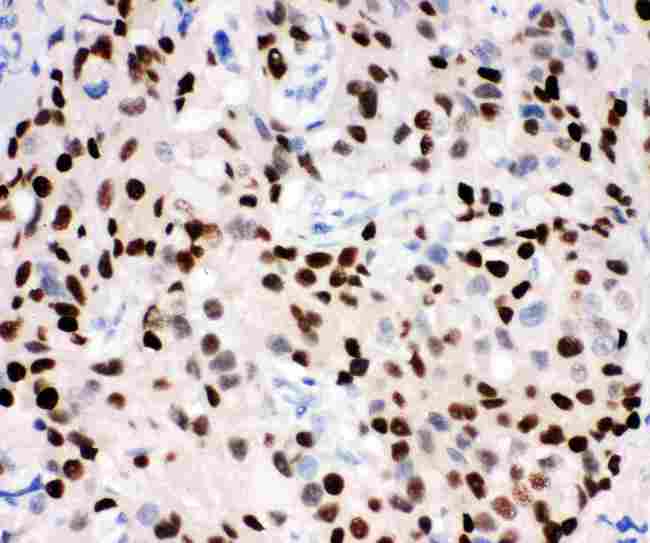 PR / Progesterone Receptor Antibody - IHC analysis of Progesterone Receptor using anti-Progesterone Receptor antibody. Progesterone Receptor was detected in paraffin-embedded section of human mammary cancer tissues. Heat mediated antigen retrieval was performed in citrate buffer (pH6, epitope retrieval solution) for 20 mins. The tissue section was blocked with 10% goat serum. The tissue section was then incubated with 1µg/ml rabbit anti-Progesterone Receptor Antibody overnight at 4°C. Biotinylated goat anti-rabbit IgG was used as secondary antibody and incubated for 30 minutes at 37°C. The tissue section was developed using Strepavidin-Biotin-Complex (SABC) with DAB as the chromogen.