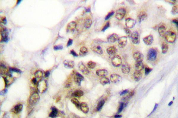 PR / Progesterone Receptor Antibody - IHC of PR (A394) pAb in paraffin-embedded human breast carcinoma tissue.