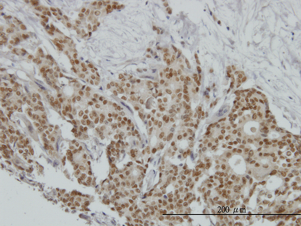 PR / Progesterone Receptor Antibody - Immunoperoxidase of monoclonal antibody to PGR on formalin-fixed paraffin-embedded human breast cancer. [antibody concentration 3 ug/ml]