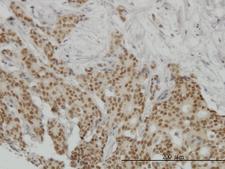 PR / Progesterone Receptor Antibody - Immunoperoxidase of monoclonal antibody to PGR on formalin-fixed paraffin-embedded human breast cancer. [antibody concentration 3 ug/ml]
