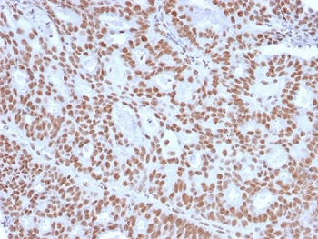 PR / Progesterone Receptor Antibody - IHC staining of FFPE human endometrial carcinoma with Progesterone Receptor antibody (clone PGR/2694). HIER: boil tissue sections in pH6, 10mM citrate buffer, for 10-20 min and allow to cool before testing.