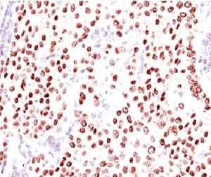 PR / Progesterone Receptor Antibody - IHC testing of FFPE human breast carcinoma with Progesterone receptor antibody (clone PGSR17).  This image was taken for the unmodified form of this product. Other forms have not been tested.