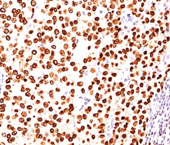 PR / Progesterone Receptor Antibody - Progesterone Receptor antibody PR484 immunohistochemistry breast carcinoma.  This image was taken for the unmodified form of this product. Other forms have not been tested.