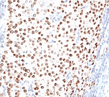 PR / Progesterone Receptor Antibody - Progesterone Receptor antibody PR500 immunohistochemistry breast carcinoma.  This image was taken for the unmodified form of this product. Other forms have not been tested.