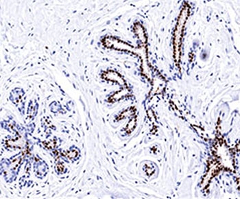 PR / Progesterone Receptor Antibody - Progesterone Receptor antibody PR501 immunohistochemistry breast.  This image was taken for the unmodified form of this product. Other forms have not been tested.