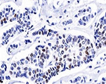 PR / Progesterone Receptor Antibody - Progesterone Receptor antibody PR501 immunohistochemistry invasive ductal carcinoma.  This image was taken for the unmodified form of this product. Other forms have not been tested.