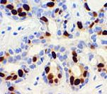 PR / Progesterone Receptor Antibody - IHC of Progesterone Receptor on FFPE Breast Carcinoma tissue. This image was taken for the unmodified form of this product. Other forms have not been tested.
