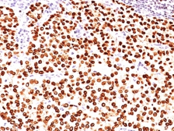 PR / Progesterone Receptor Antibody - Formalin-fixed, paraffin-embedded human breast carcinoma stained with anti-Progesterone Receptor antibody (SPM566).  This image was taken for the unmodified form of this product. Other forms have not been tested.