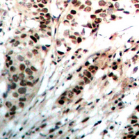 PR / Progesterone Receptor Antibody - Immunohistochemical analysis of Progesterone Receptor staining in human breast cancer formalin fixed paraffin embedded tissue section. The section was pre-treated using heat mediated antigen retrieval with sodium citrate buffer (pH 6.0). The section was then incubated with the antibody at room temperature and detected using an HRP conjugated compact polymer system. DAB was used as the chromogen. The section was then counterstained with hematoxylin and mounted with DPX.