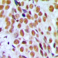 PR / Progesterone Receptor Antibody - Immunohistochemical analysis of Progesterone Receptor staining in human breast cancer formalin fixed paraffin embedded tissue section. The section was pre-treated using heat mediated antigen retrieval with sodium citrate buffer (pH 6.0). The section was then incubated with the antibody at room temperature and detected using an HRP polymer system. DAB was used as the chromogen. The section was then counterstained with hematoxylin and mounted with DPX.
