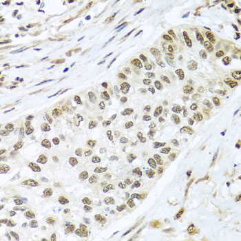 PR / Progesterone Receptor Antibody - Immunohistochemistry of paraffin-embedded human lung cancer tissue.