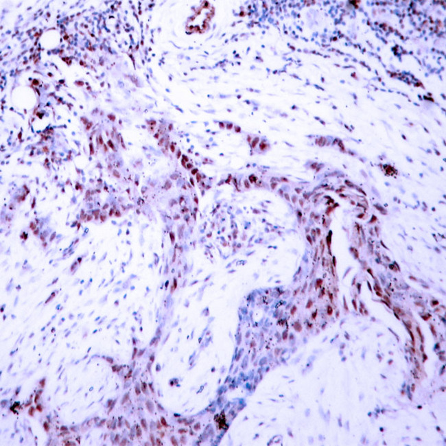 PR / Progesterone Receptor Antibody - Immunohistochemistry analysis of paraffin-embedded human breast carcinoma, using Progesterone Receptor (Phospho-Ser190) Antibody.