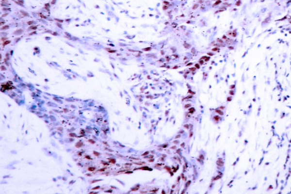 PR / Progesterone Receptor Antibody - IHC of p-Progesterone Receptor (S190) pAb in paraffin-embedded human breast carcinoma tissue.